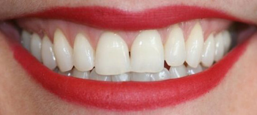 Teeth Whitening at 92 Dental